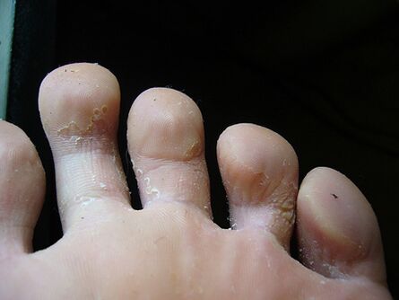 Ljuštenje i perutanje kože na nogama znak je gljivica