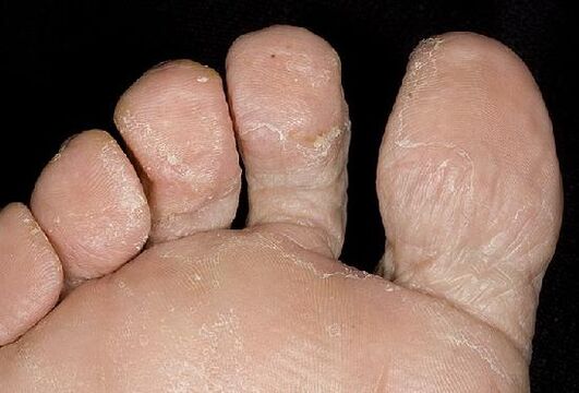 Manifestacije gljivične infekcije na nogama