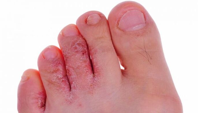 gljivična infekcija kože nožnih prstiju