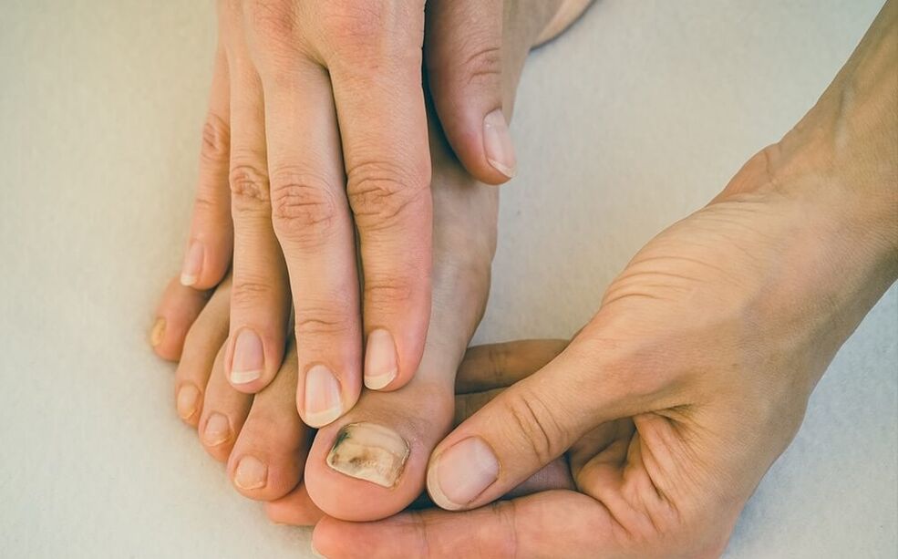 gljivice na noktima kako liječiti