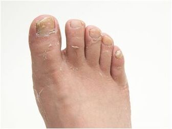 simptomi gljivica stopala