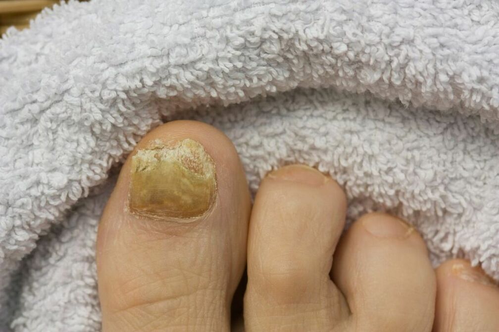 Atrofični stadij gljivice (otpadanje komadića nokta na nozi)