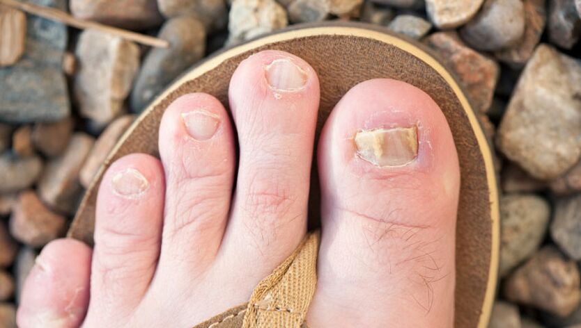 Gljivice noktiju na nogama