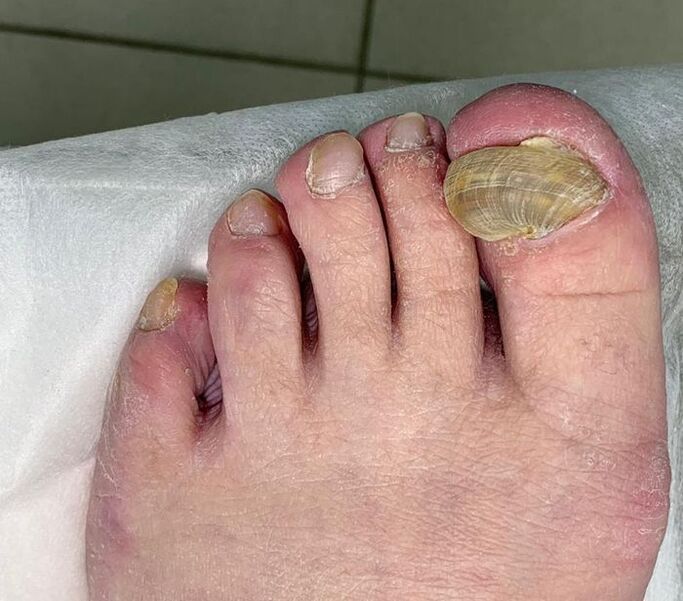 Hipertrofična onihomikoza na nozi - deformirani nokat