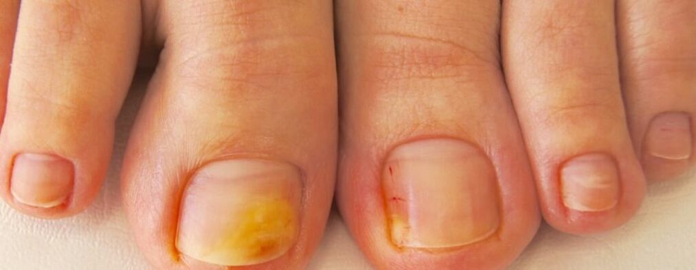 Početna faza onihomikoze - žutilo noktiju na nogama