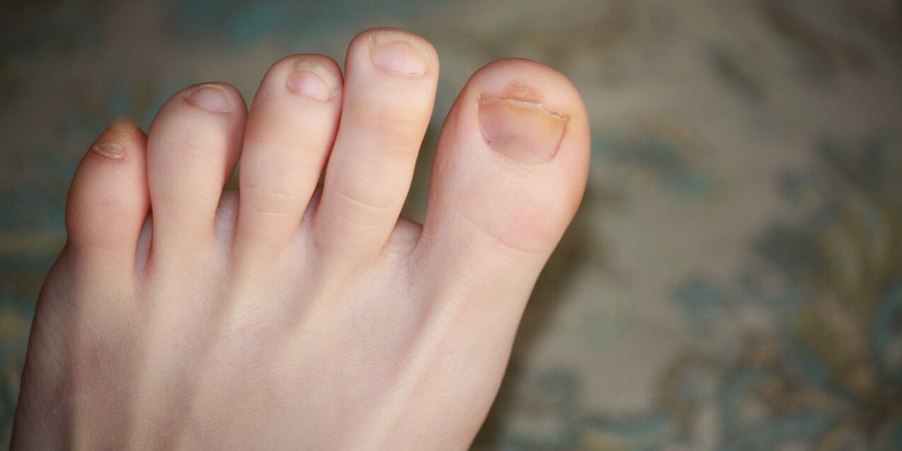 gljivice noktiju na nogama