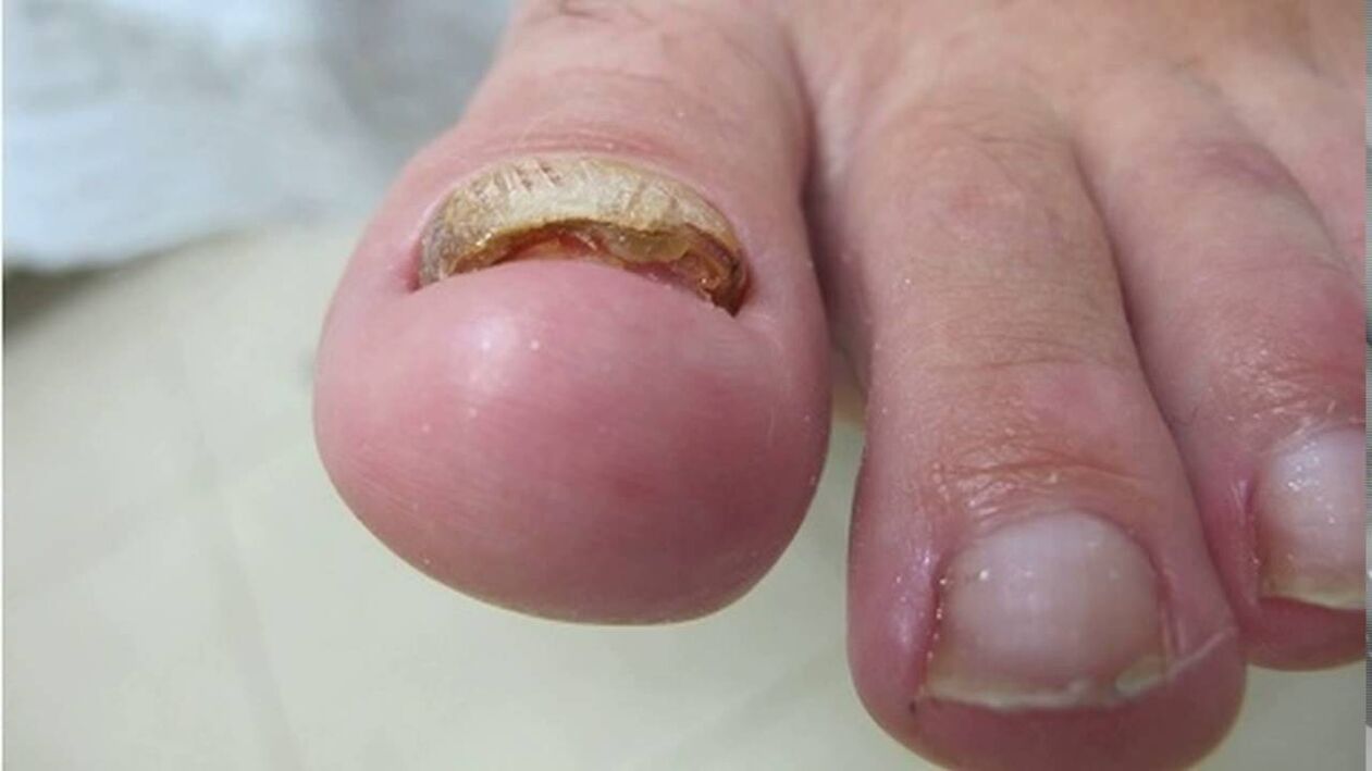 Hipertrofična gljiva - deformacija ruba, gubitak boje i zadebljanje ploče nokta