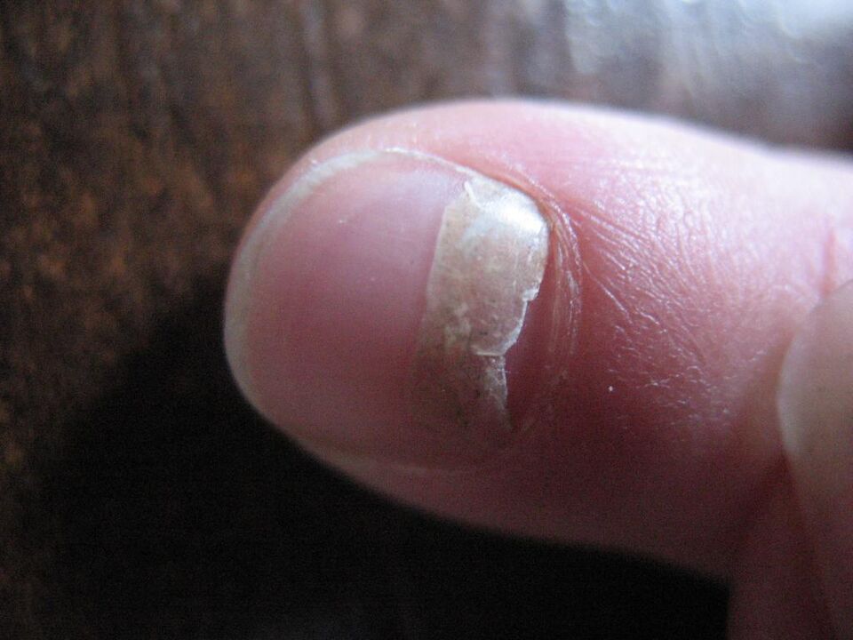 Onikolitička vrsta gljivica popraćena je odvajanjem ploče nokta