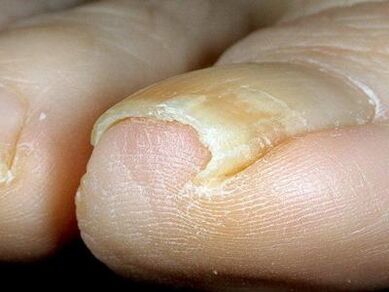 Izgled noktiju na nogama zaraženih gljivicama