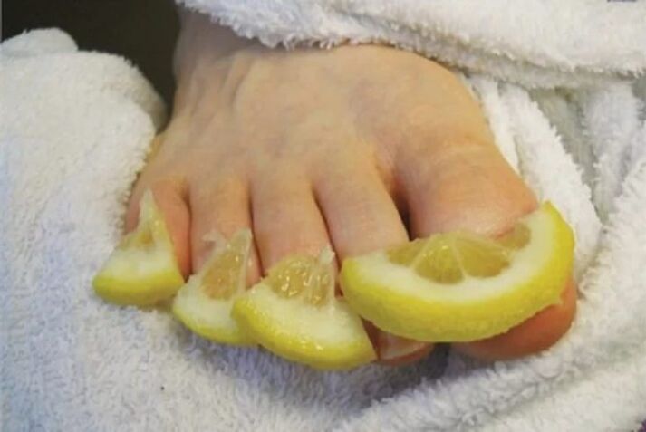 Oblozi od limunovih kapi - narodni lijek za gljivice noktiju na nogama